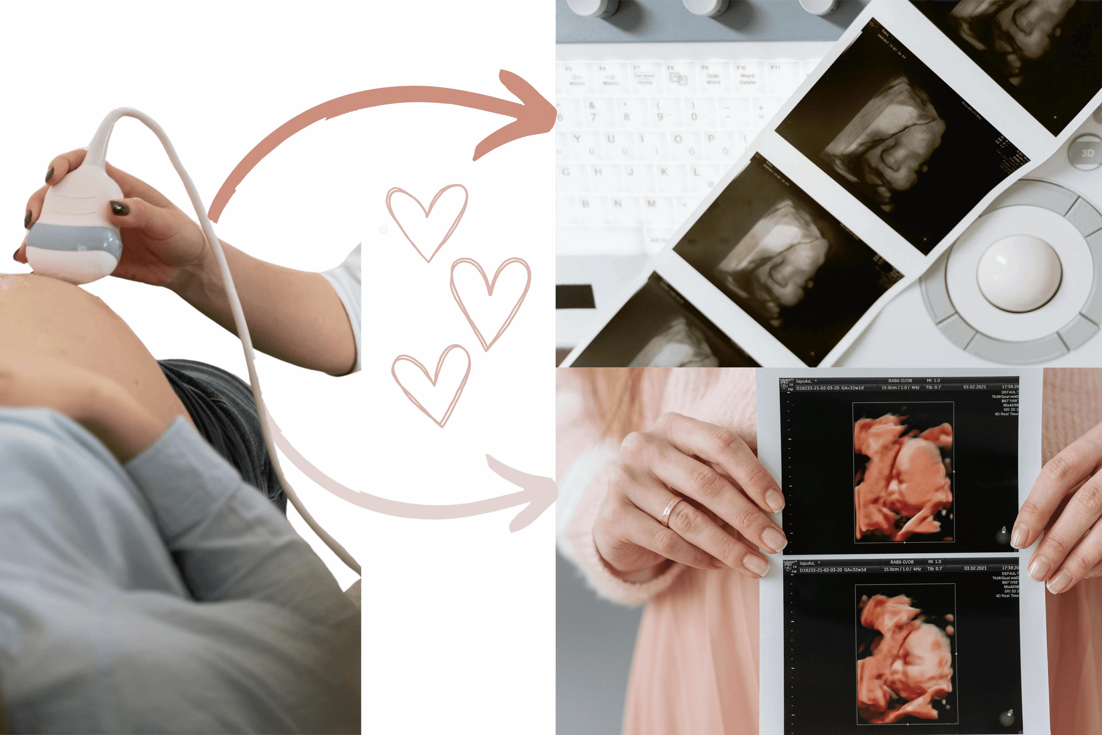 4D ultrazvuková rekonstrukce plodu